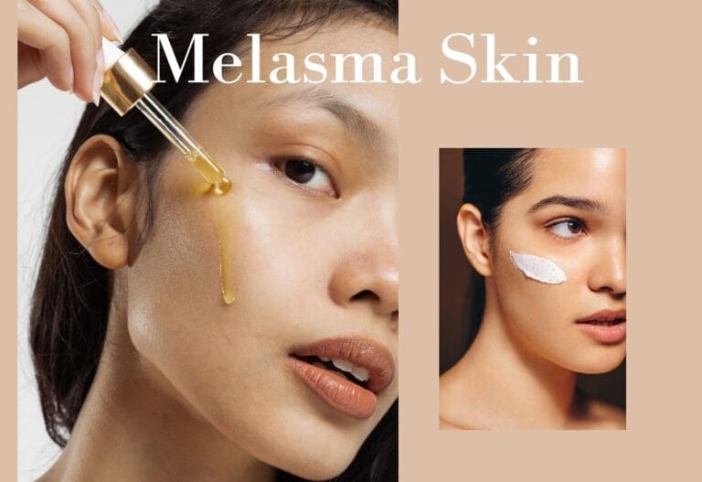 melasma treatment